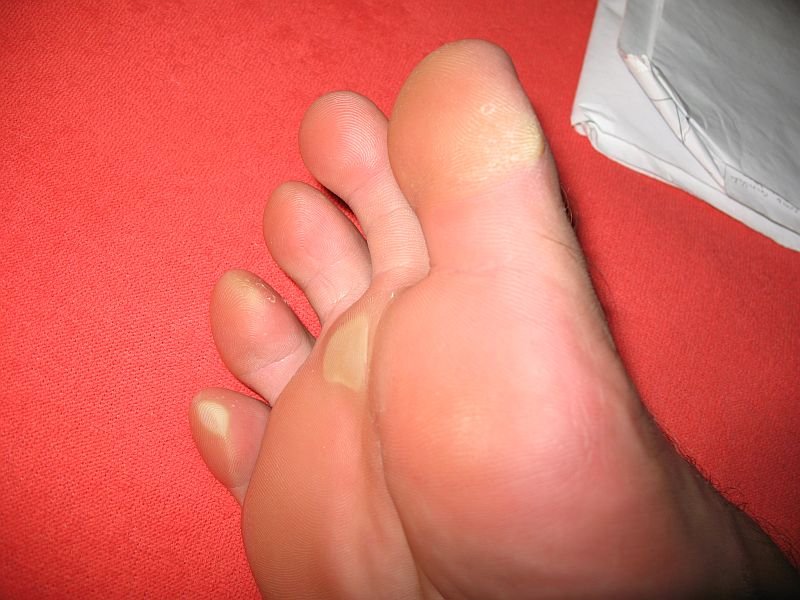 https://www.healthtipsinfo.com/wp-content/uploads/2019/07/callus-on-feet.jpg