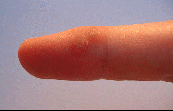 https://www.healthtipsinfo.com/wp-content/uploads/2019/07/callus-on-finger.png